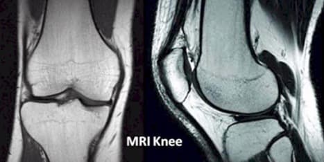 Chụp cộng MRI hay CT bổ trợ cho nhau trong chẩn đoán chấn thương khớp gối
