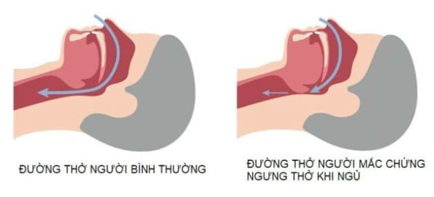 Hội chứng ngưng thở khi ngủ là một hội chứng điển hình của bệnh rối loạn giấc ngủ