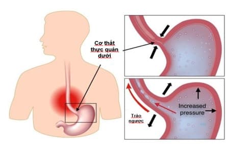 Hình ảnh minh hoạ trào ngược dạ dày thực quản