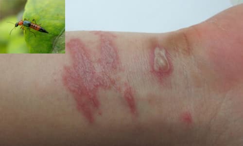 Biểu hiện viêm da tiếp xúc do kiến ba khoang đốt