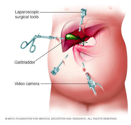 Mổ nội soi cắt túi mật