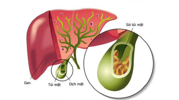 Tùy vào tình trạng bệnh mà có phác đồ điều trị sỏi túi mật khác nhau.