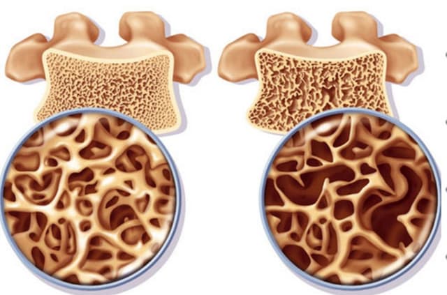 Bệnh loãng xương – dấu hiệu nhận biết, cách điều trị