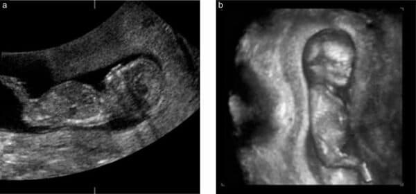 Các chiều siêu âm thai 4D và 2D, 3D