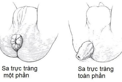 các mức độ sa trực tràng 