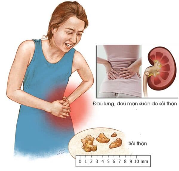Cần chữa sỏi thận sớm tránh những biến chứng