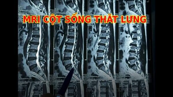 chụp MRI cột sống thắt lưng
