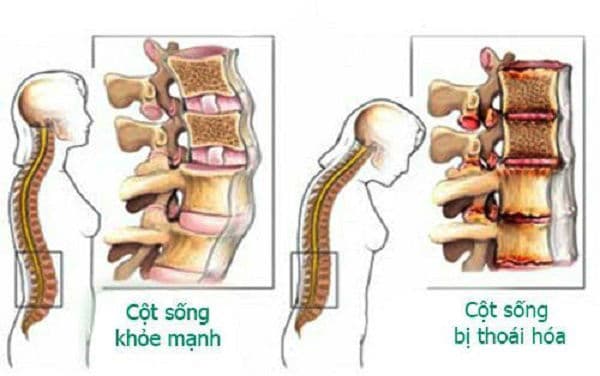 Chụp x quang cột sống thắt lưng hoái hóa cột sống thắt lưng
