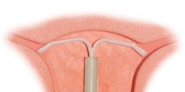 Dấu hiệu nên tháo vòng tránh thai là đau bụng