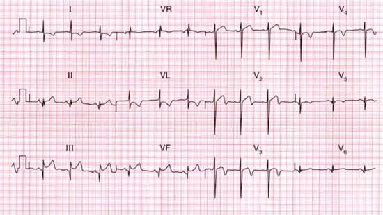 điện tâm đồ khác siêu âm tim