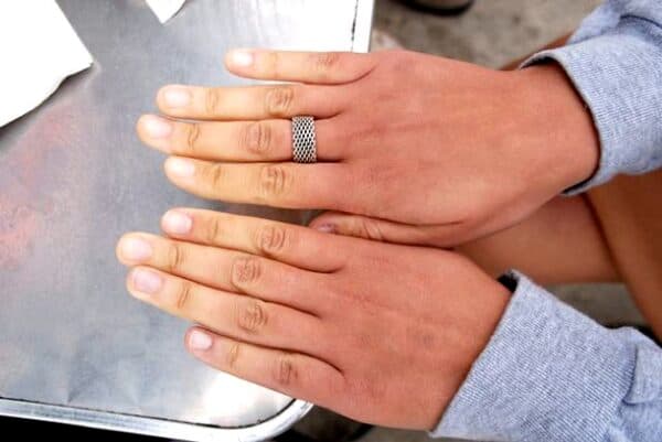 Biểu hiện đặc trưng của hội chứng raynaud là sự thay đổi màu da