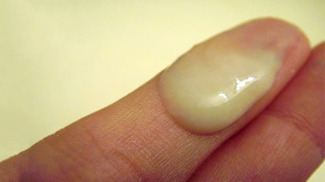 Khí hư vón cục màu vàng – báo động đỏ về sức khỏe