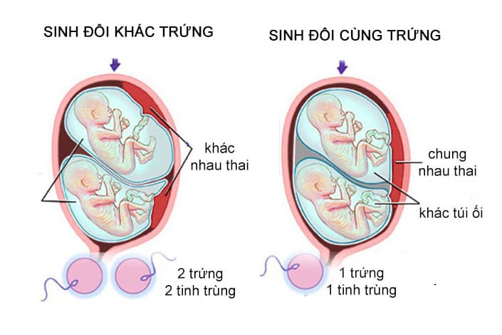 Sự khác biệt giữa thai đôi cùng trứng và thai đôi khác trứng