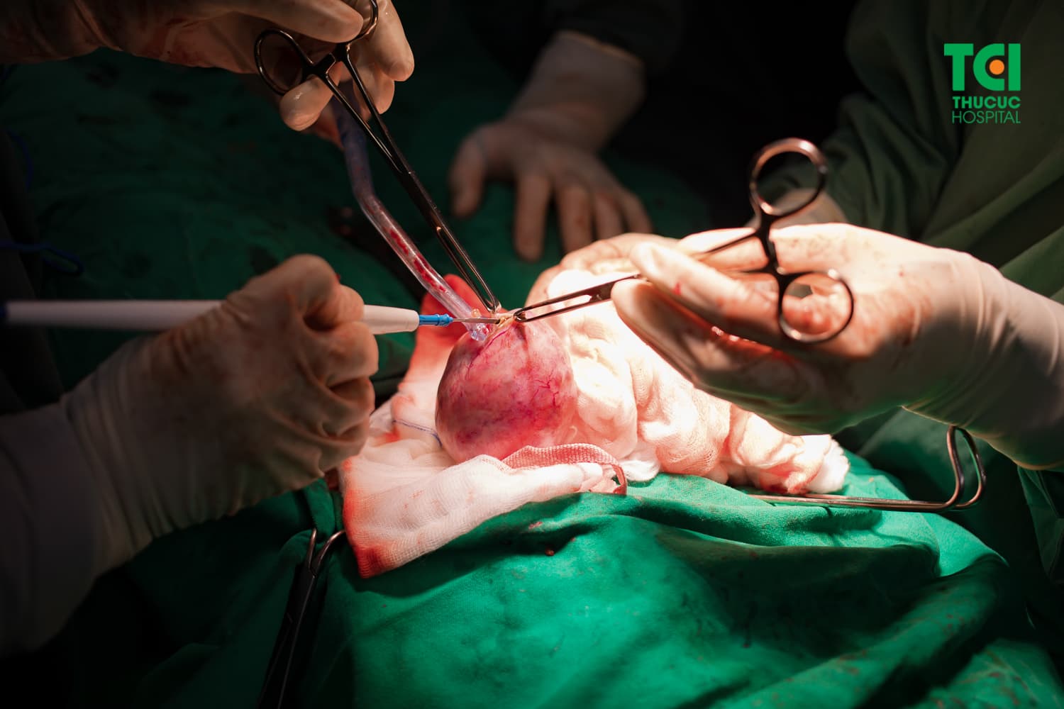 Hình ảnh khối u xơ được bác sĩ bệnh viện ĐKQT Thu Cúc thực hiện phẫu thuật bóc tách