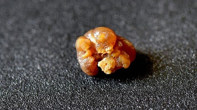 Phẫu thuật nội soi sau phúc mạc lấy sỏi niệu quản được chỉ định trong một số trường hợp nhất định