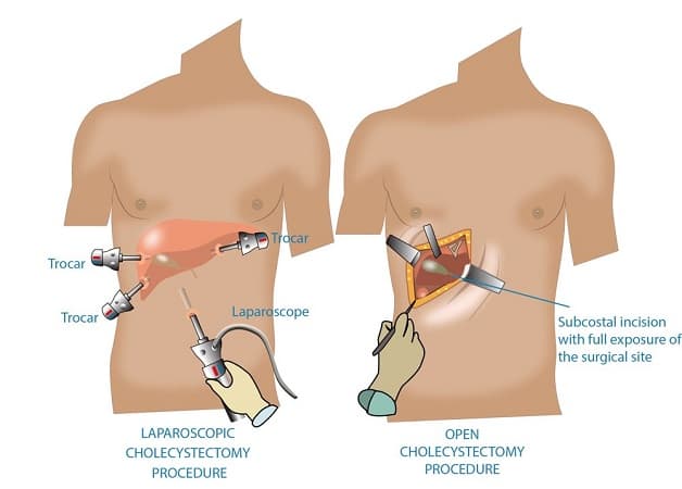 Các phương pháp phẫu thuật điều trị bệnh viêm túi mật cấp