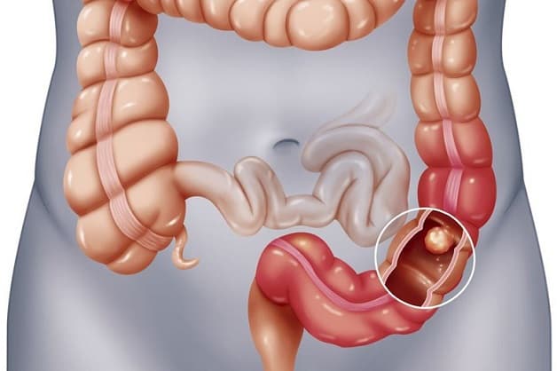 Polyp đại trực tràng là bệnh tiêu hóa thường gặp
