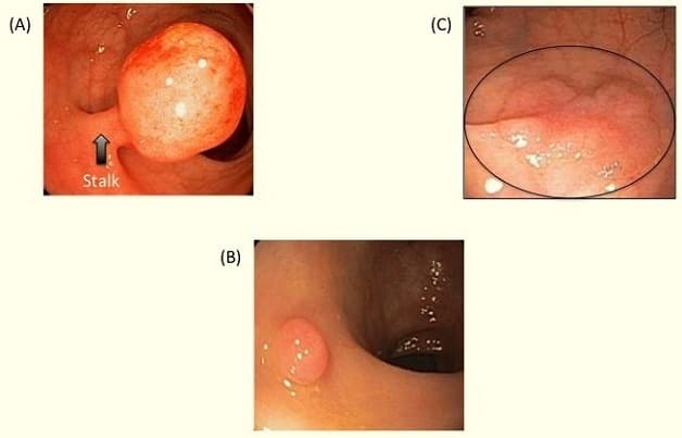 Có nhiều loại polyp đại trực tràng khác nhau