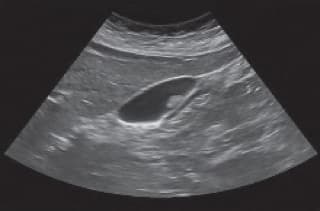 Hình ảnh trên siêu âm của một trường hợp polyp túi mật.