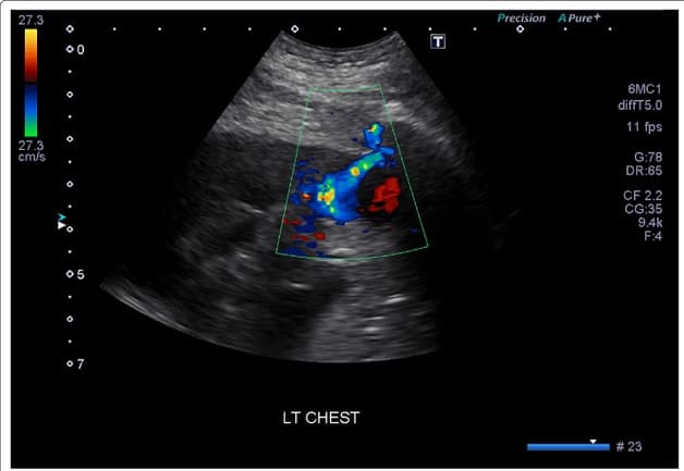Hình ảnh siêu âm màu