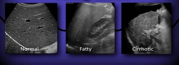 Hình ảnh siêu âm gan