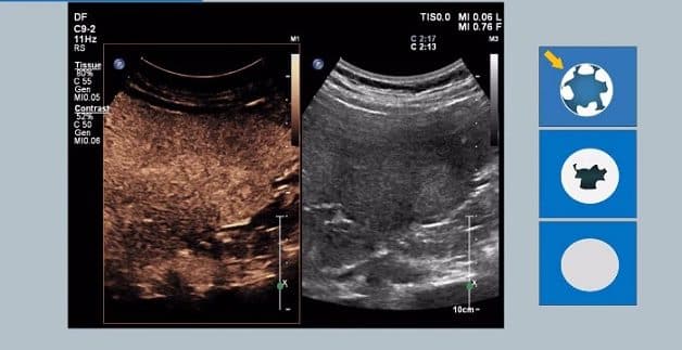 Siêu âm gan có tăng cường phản âm