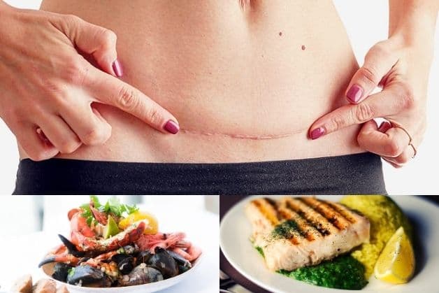 Sinh mổ bao lâu được ăn hải sản là câu hỏi rất nhiều thai phụ quan tâm