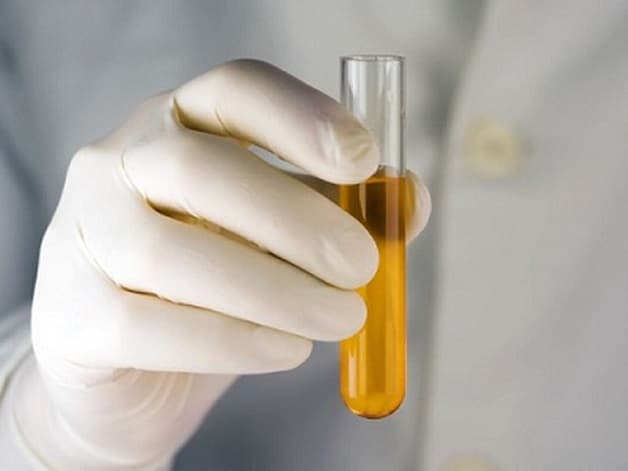 Dấu hiệu sỏi bàng quang thường gặp nhất là nước tiểu thường có màu vàng đậm hơn, có mùi lạ và rất khó chịu