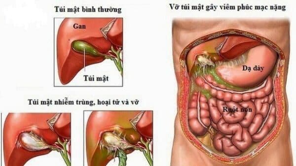 Sỏi túi mật có chữa được không là lo lắng của nhiều người bệnh bởi căn bệnh này có thể dẫn tới nhiều biến chứng nguy hiểm. 