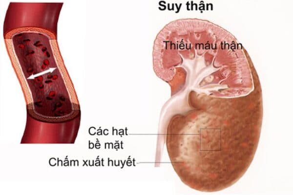 Suy thận nhẹ có một số triệu chứng ban đầu, nhưng không quá rõ ràng