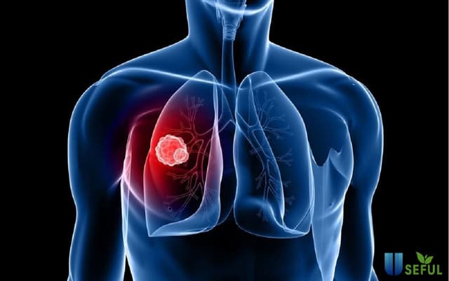 Giải đáp băn khoăn về việc tầm soát ung thư cho nam giới