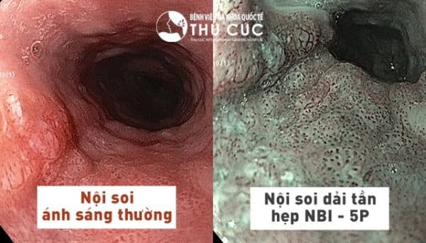 Tầm soát ung thư dạ dày ở đâu tại Hà Nội