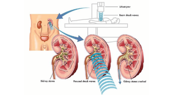 Hình ảnh minh họa cơ thế tán sỏi thận ngoài cơ thể. 