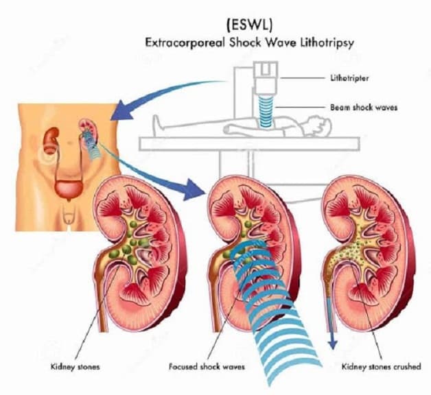 Tán sỏi ngoài cơ thể ESWL sử dụng năng lượng sóng xung kích để phá vỡ sỏi thành những mảnh nhỏ