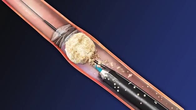 Tán sỏi nội soi ngược dòng bằng laser mang lại hiệu quả cao, an toàn