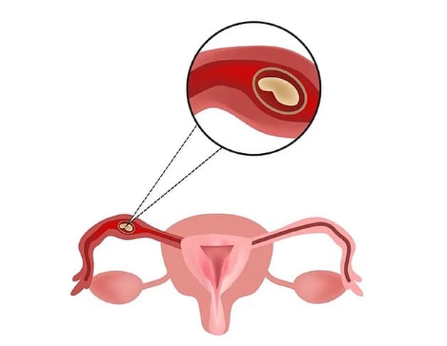 thai ngoài tử cung