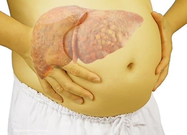 Bụng phình to kèm theo vàng da là triệu chứng điển hình của xơ gan giai đoạn cuối