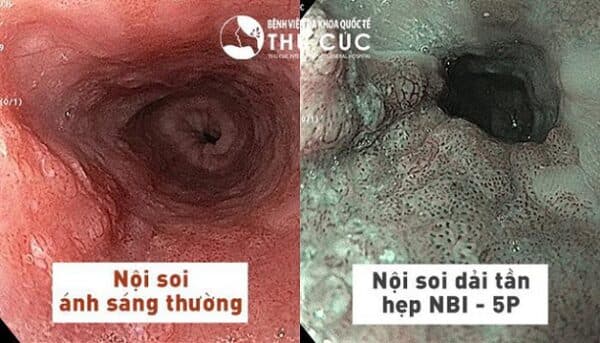ưu điểm nội soi tiêu hóa NBI