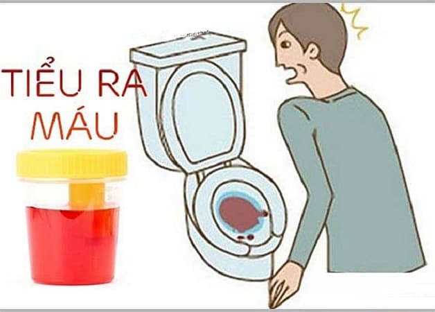 Nguyên nhân chủ yếu gây viêm đường tiết niệu tiểu ra máu là vi khuẩn E.coli