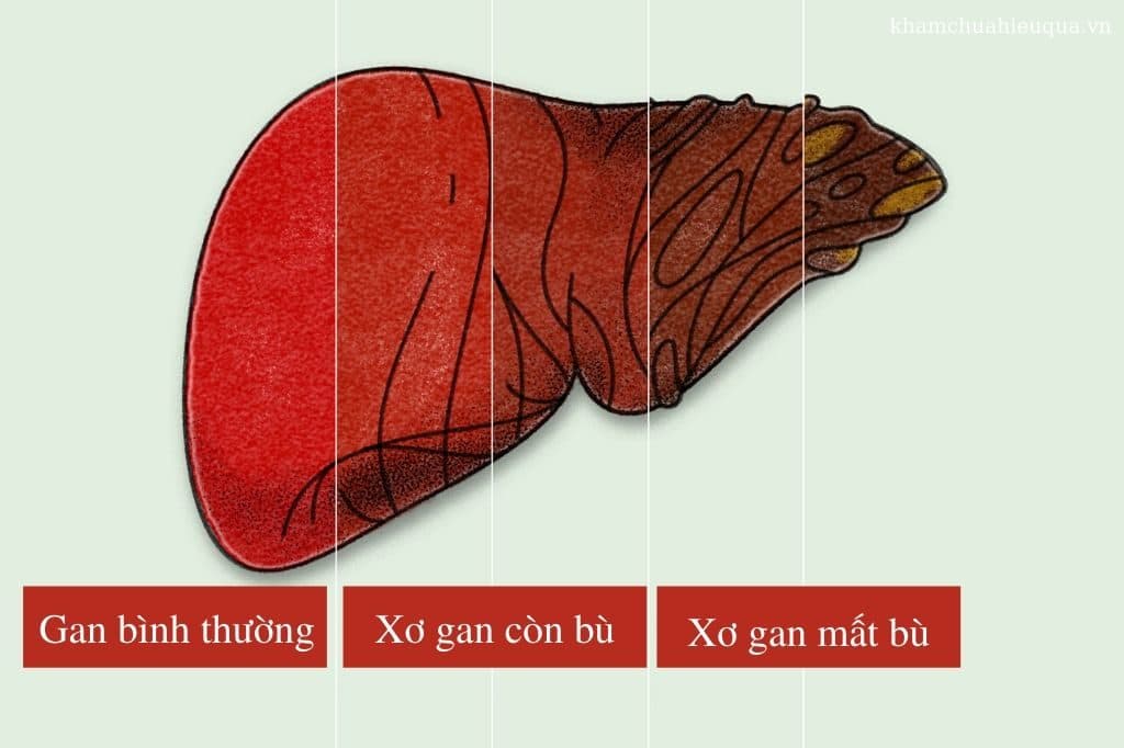 Xơ gan còn bù là gì? Cần làm gì để khắc phục tình trạng xơ gan hiện nay.
