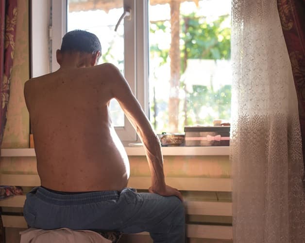 Biểu hiện xơ gan cổ trướng