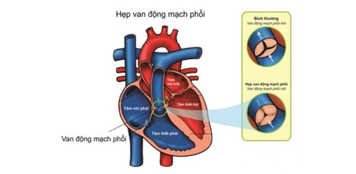 Các mức độ hẹp van động mạch phổi và cách điều trị