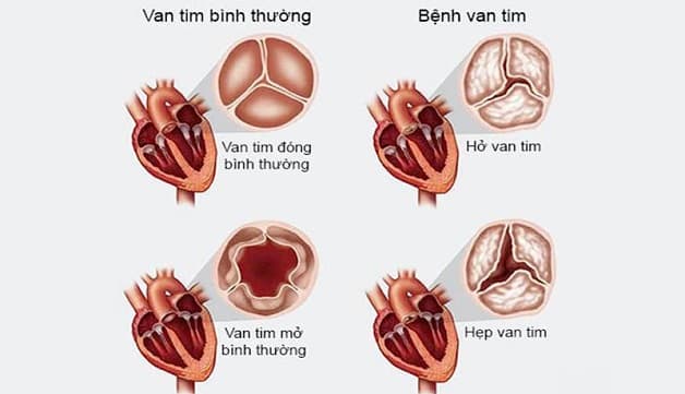 Bệnh hẹp van tim là gì 