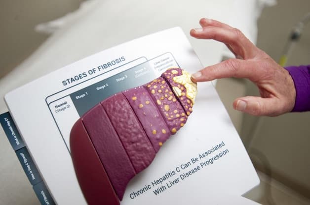 Bệnh viêm gan C gây biến chứng gì?