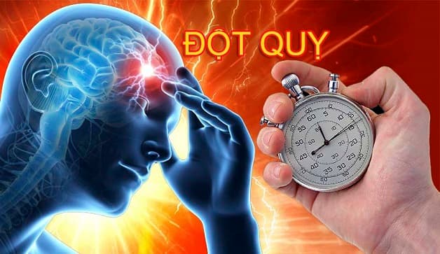 Bệnh mạch vành là nguyên nhân hàng đầu gây đột quỵ