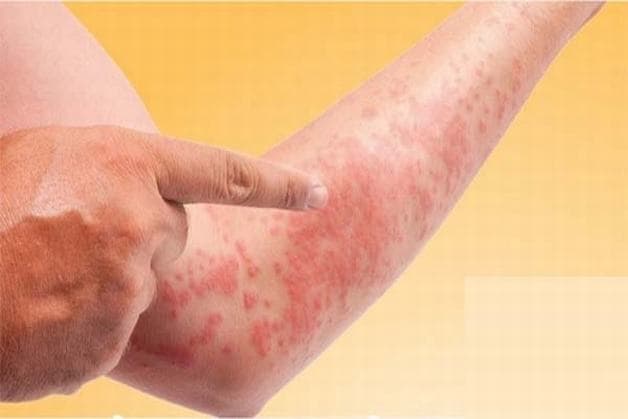 biểu hiện men gan cao là thế nào