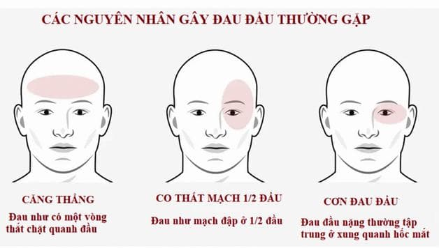 Nguyên nhân gây nhức đầu mãn tính