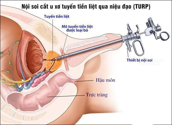 chi phí phẫu thuật u xơ tuyến tiền liệt phụ thuộc vào phương pháp điều trị là mổ nội soi hay mổ hở