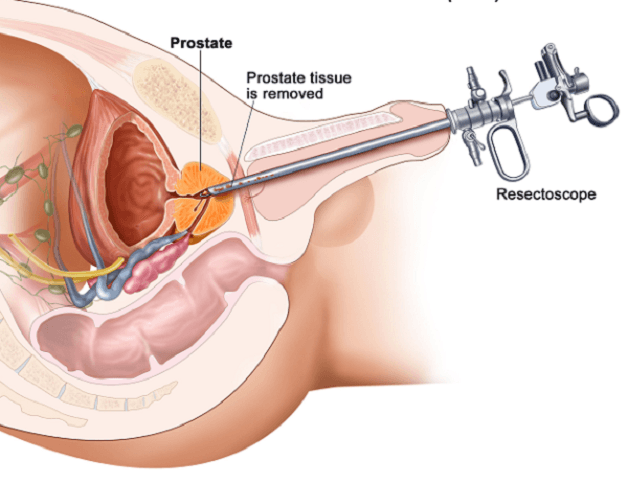 Chữa u xơ tuyến tiền liệt bằng phương pháp nội soi qua đường niệu đạo là phương pháp điều trị phổ biến