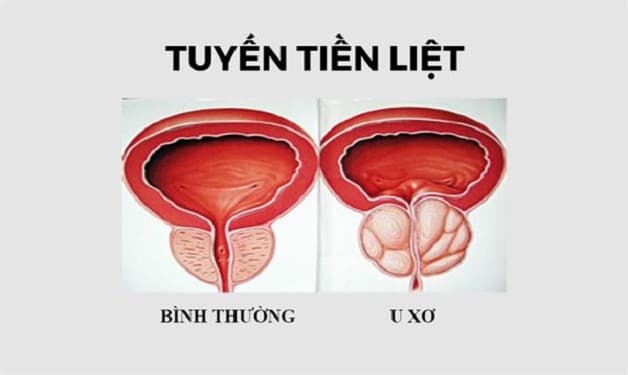 Tìm hiểu về cách chữa u xơ tuyến tiền liệt hiệu quả